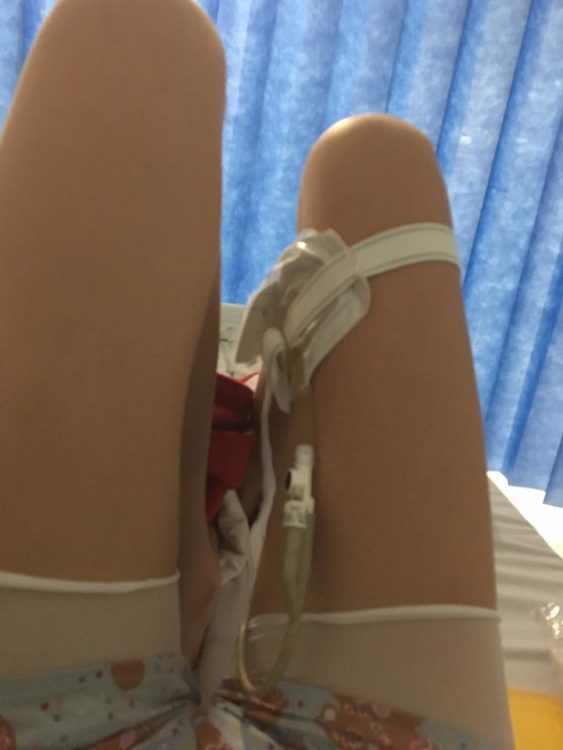 woman's legs and catheter device