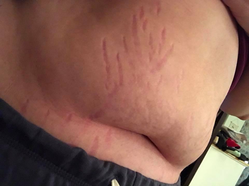 woman's stomach with red marks resembling stretch marks