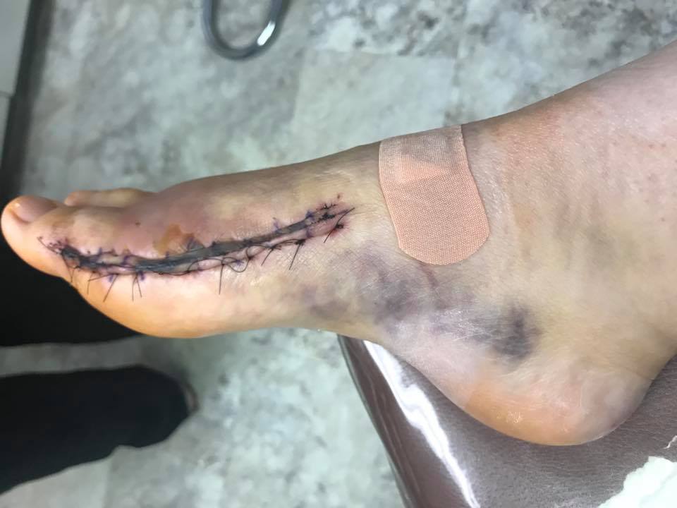 woman with stitches on the inner side of her right foot plus bruising