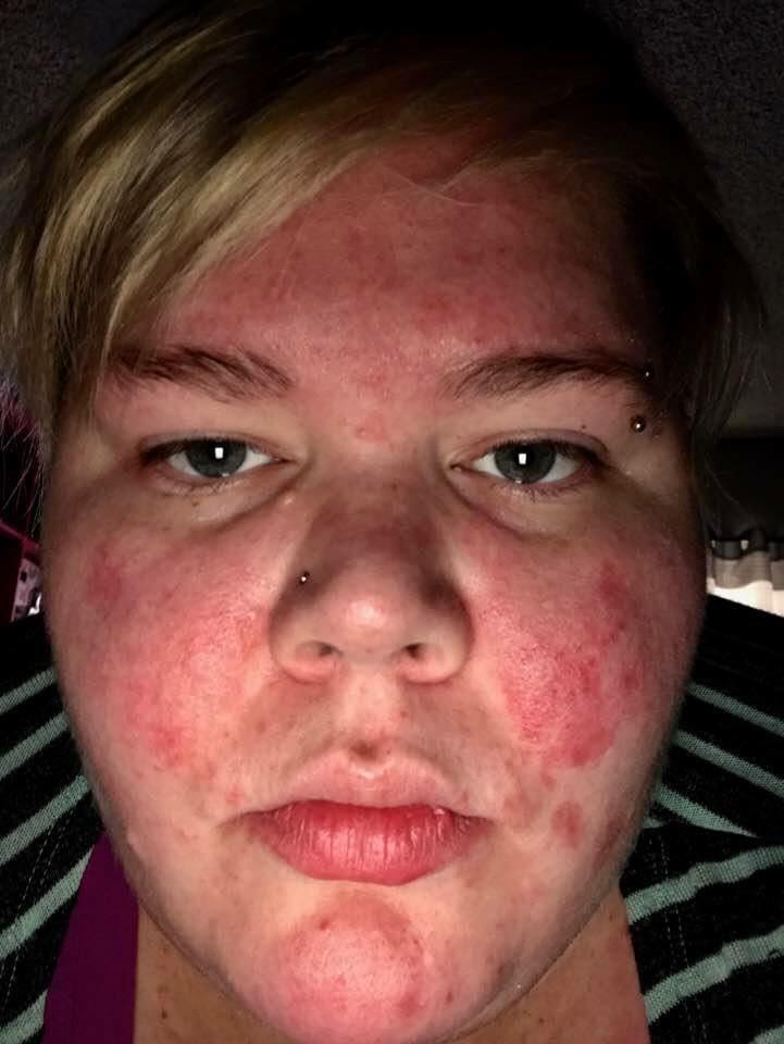 26 Photos That Show How Autoimmune Disease Can Affect Your Skin