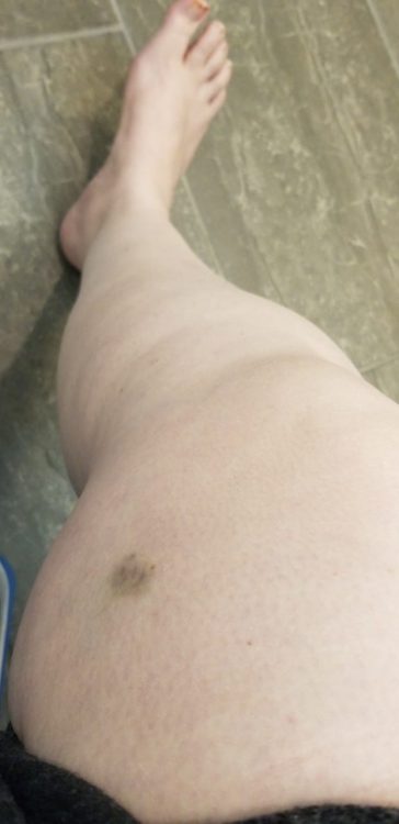 bruise on leg