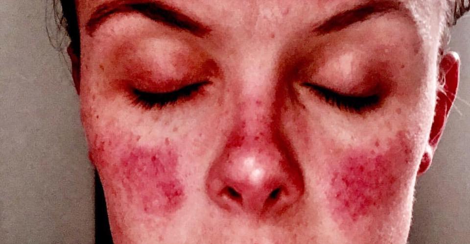 close-up photo of woman's face with butterfly rash