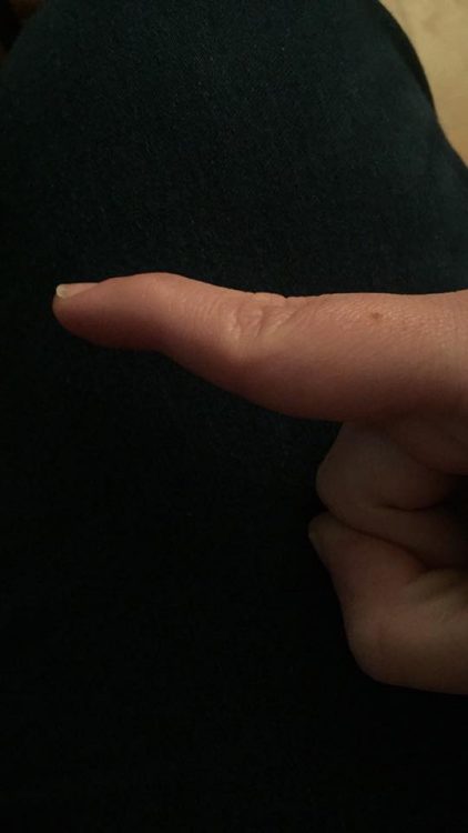 finger with dislocated joint