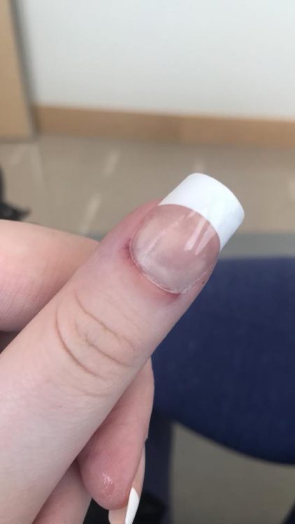 bruise under nail