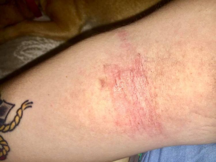 arm with red marks from irritation