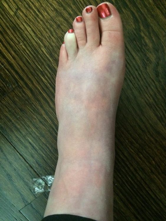 foot with purple blotches and white toe