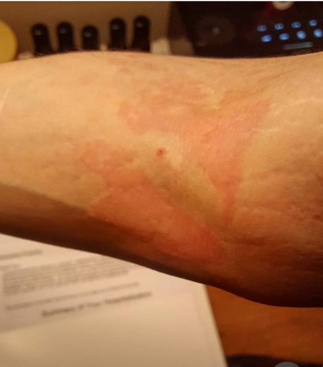 rash on inside of arm