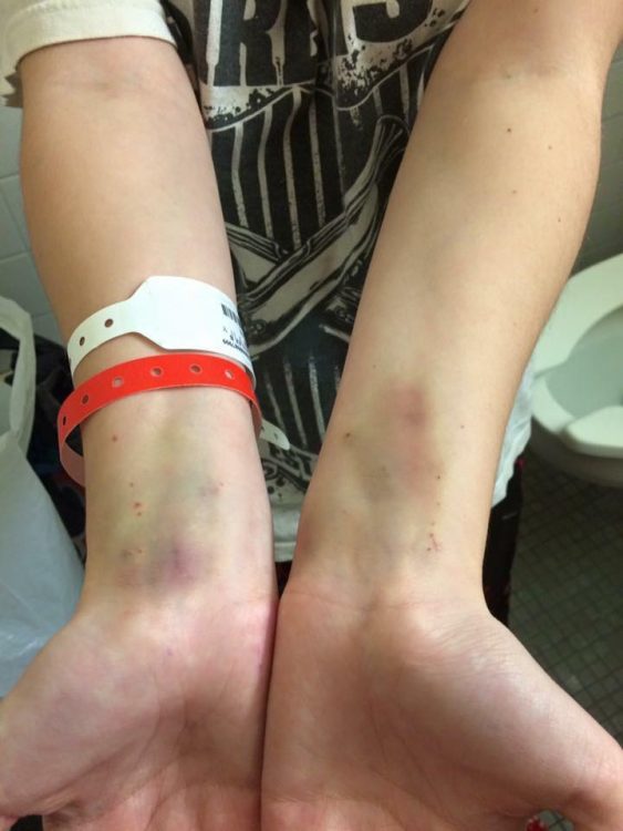 collapsed veins on arms of girl wearing hospital bracelets