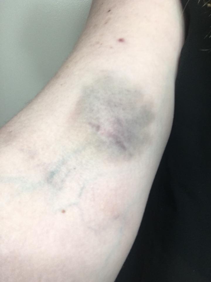 woman with large purple bruise on her arm