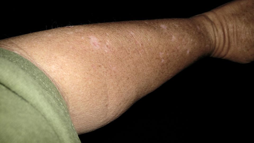 neurodermatitis rash and scarring on a woman's arm