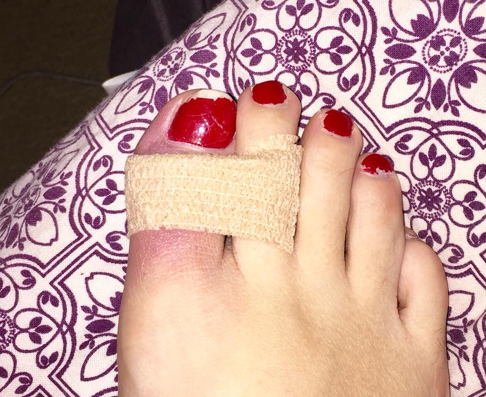 woman foot with the big toe and second toe wrapped together