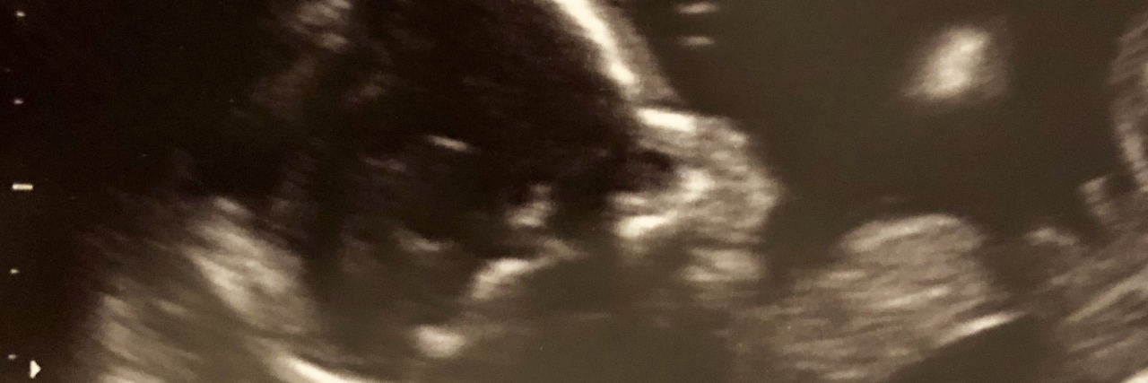 What I Would Tell Myself on the Day My Baby Was Diagnosed