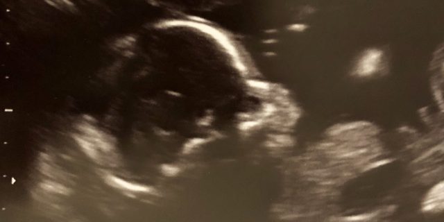 When My Baby Received a Prenatal Diagnosis of CDH