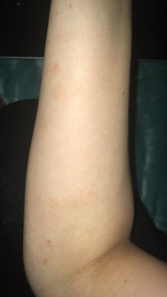 rash on a woman's arm