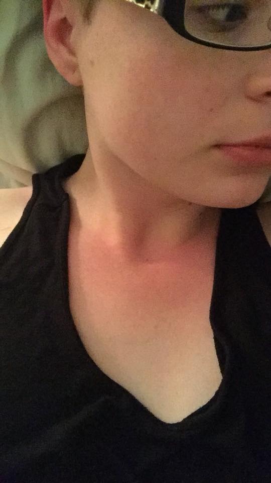 red blotchy rash on a woman's chest