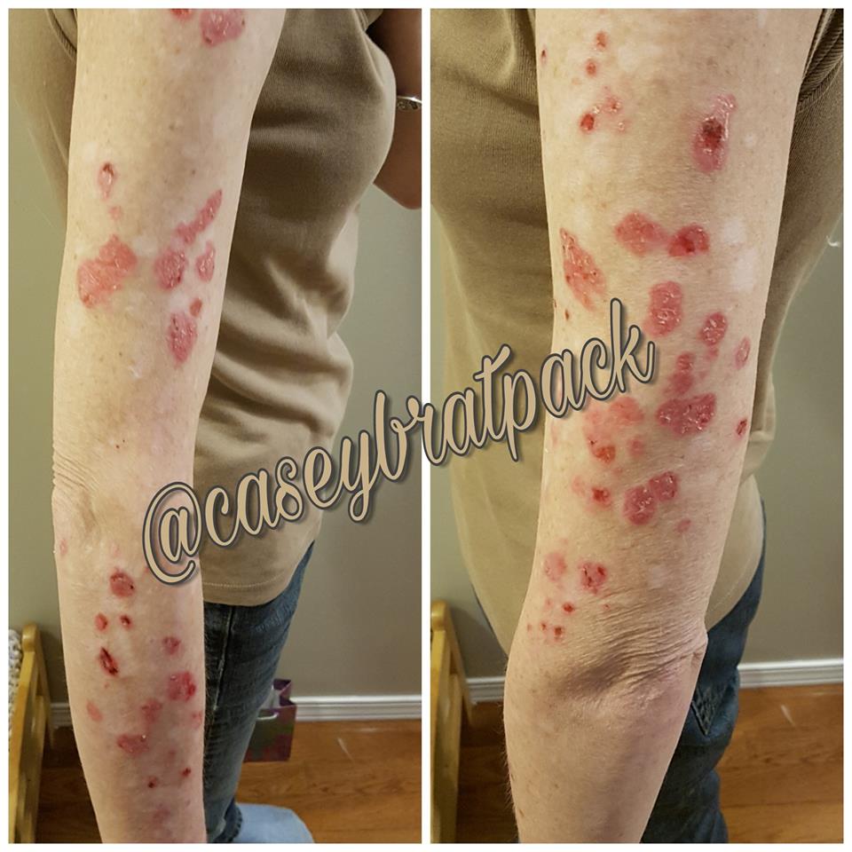 red circular spots on a woman's arms