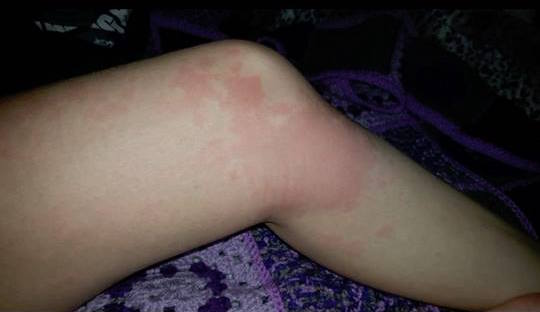 red blotchy rash on a woman's knee