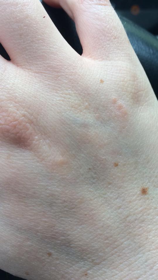 woman's hand with dry, flaky skin