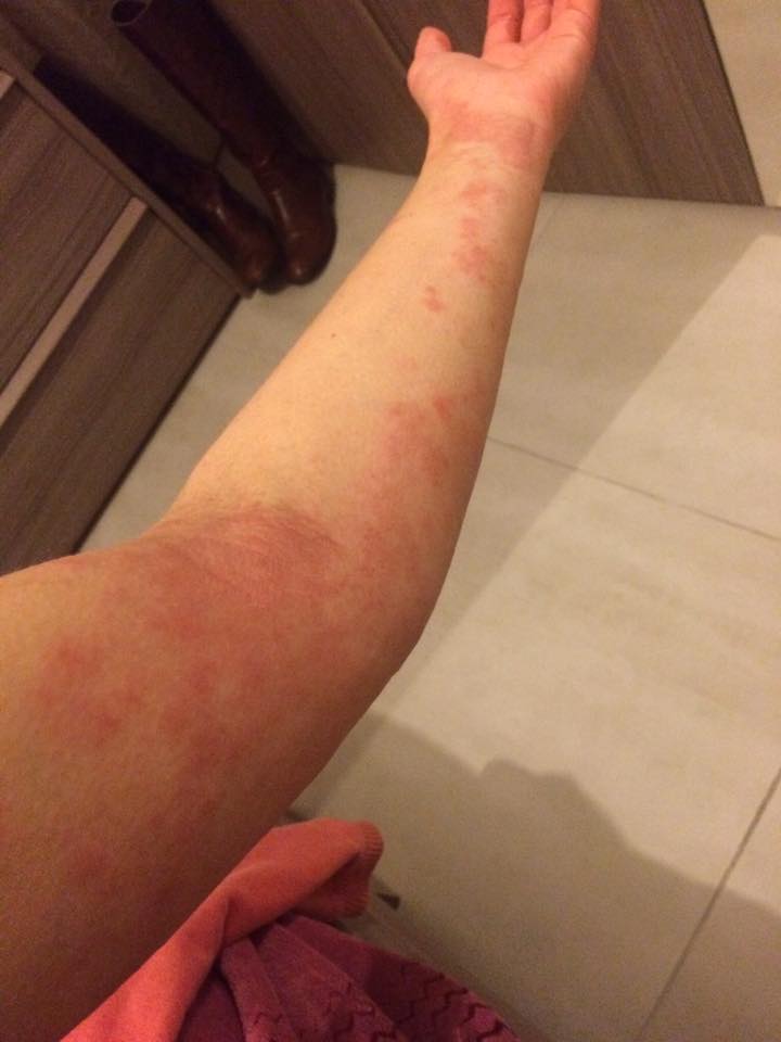 red splotchy rash on a woman's arm