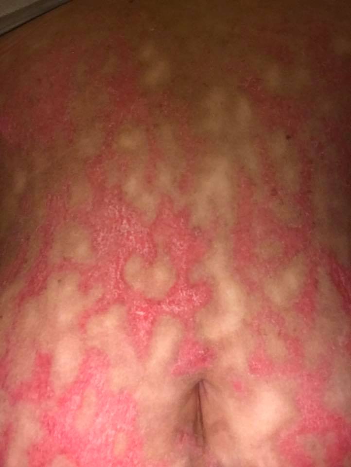 Photos Showing Autoimmune Disease Affect on Skin