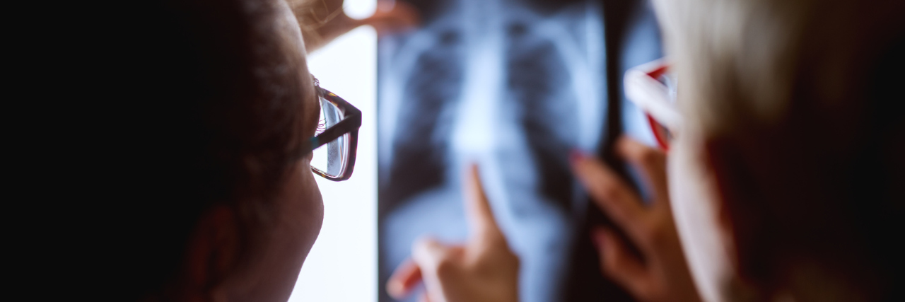 Why It's Important to Get a Second Opinion A doctor and patient reviewing a chest X-ray.