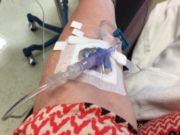 Jill's arm during an infusion