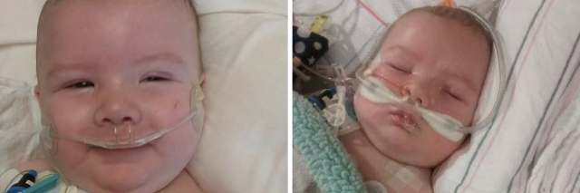 Two images, side by side, of baby after surgery. In one he is smiling, in the other he is sleeping. he has wires all over him.