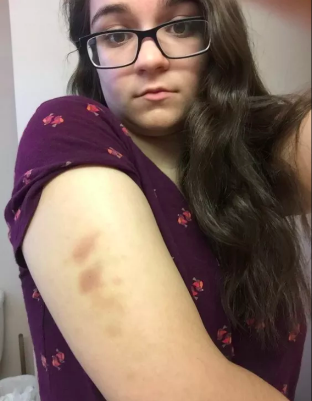 woman with bruises on her arm
