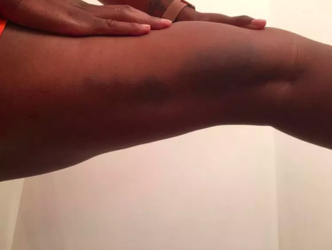 bruises on a woman's leg