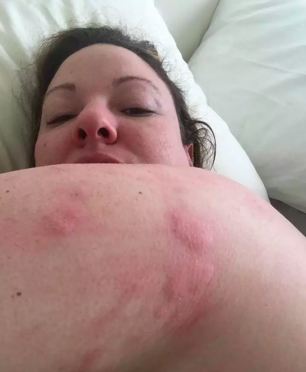 red raised welts on a woman's arm