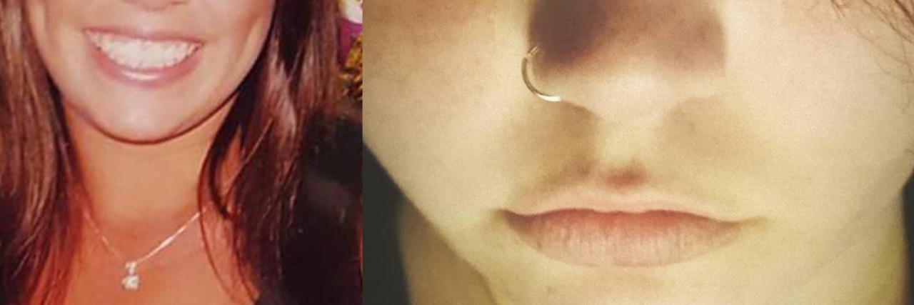 Trigeminal Neuralgia: The Thief That Stole My Smile side-by-side comparisons of the author's face before TN and after