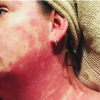 left photo: woman with a red autoimmune disease rash on her neck. right photo: man with freckles on his face.