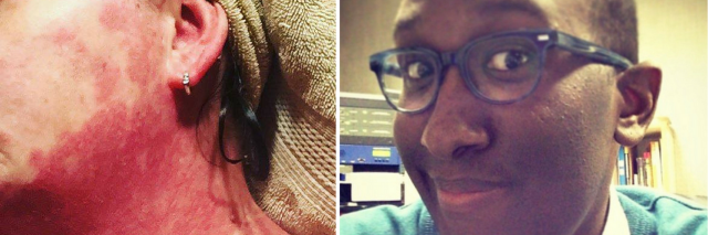 26 Photos That Show How Autoimmune Disease Affects the Skin