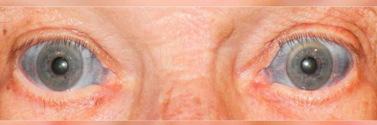 Man’s Eyes Turn Blue After 15 Years on Antibiotic for Arthritis Man's eyes with blue tint