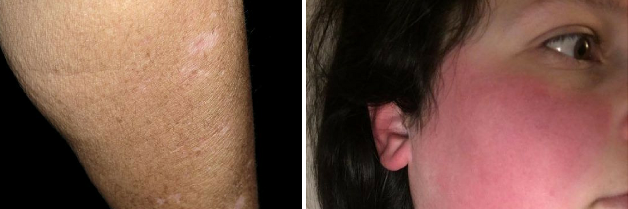 neurodermatitis rash and scarring on a woman's arm, and a woman with flushed red cheeks