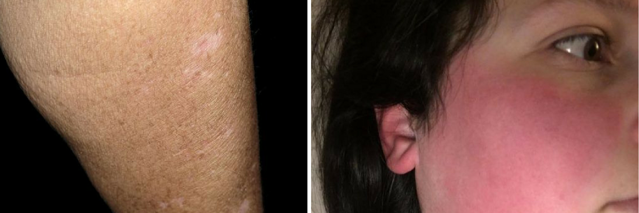 16 Photos That Show How Fibromyalgia Can Affect Your Skin neurodermatitis rash and scarring on a woman's arm, and a woman with flushed red cheeks