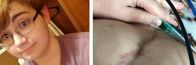 photo of woman showing flushed red ears and photo of scar on woman's stomach