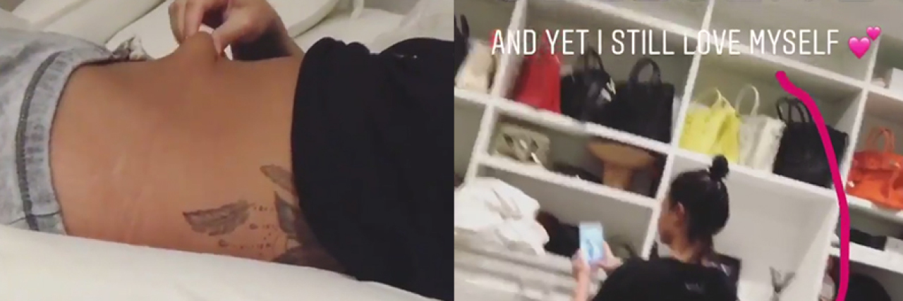 Demi Lovato Inspires Body Positive #ILoveMe Hashtag Demo Lovato lying in bed pinching the fat on her stomach, next to a photo of demo Lovato standing, her back facing the camera. Text reads: Cellulite with an arrow pointing to under her butt