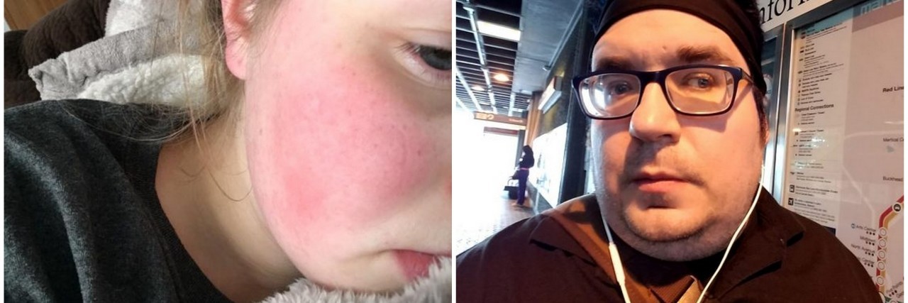13 Little-Known Symptoms of Fibromyalgia in Photos woman with flushed cheeks and man wearing sweatband