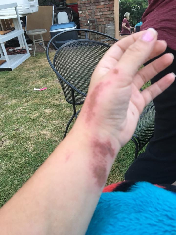 woman with chemical burns from medication on her hand and wrist