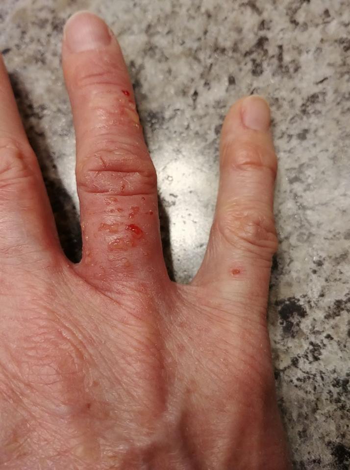woman with red cracked skin on her fingers