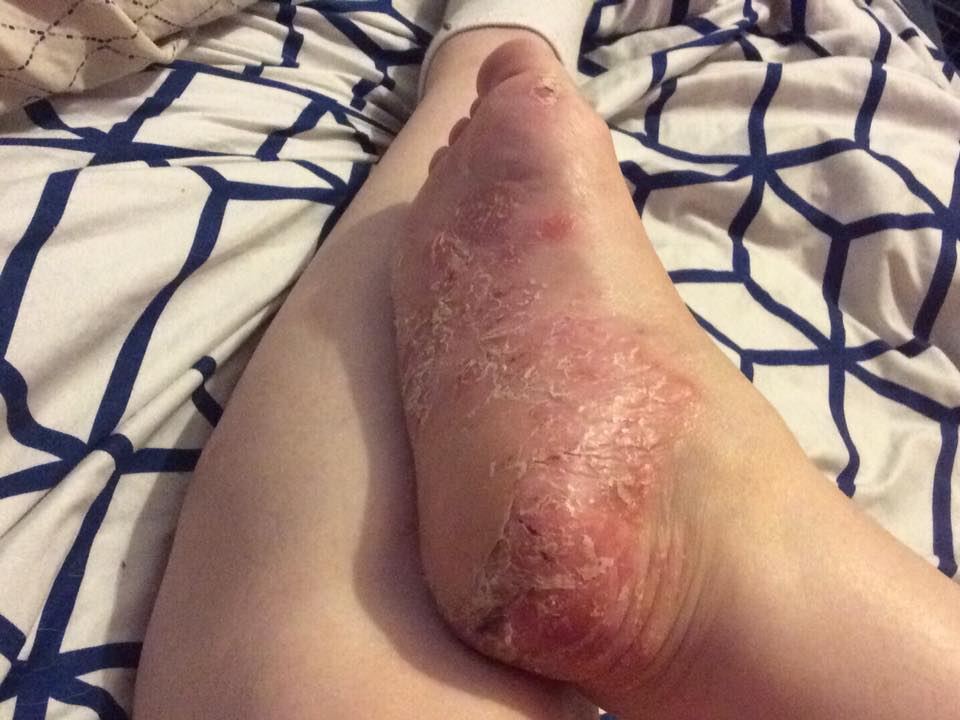 psoriasis on the bottom of a woman's foot
