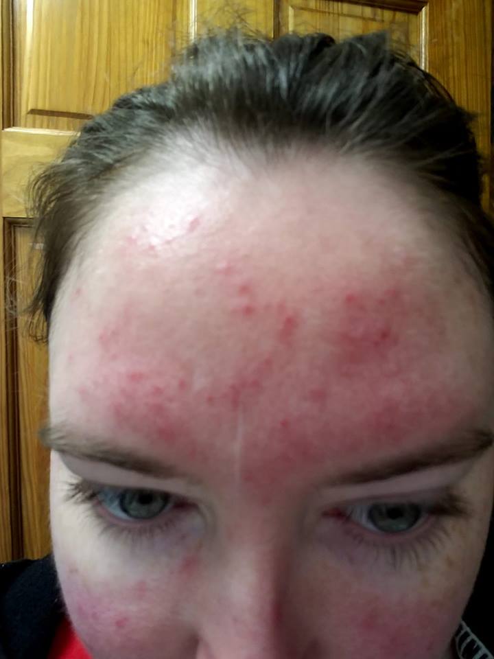 woman with rosacea on her face