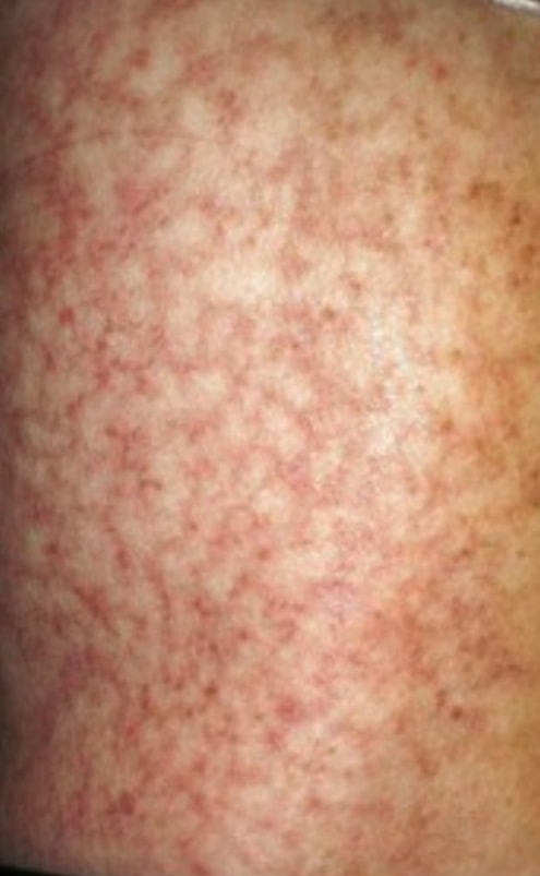 Livedoid Vasculopathy on a woman's skin