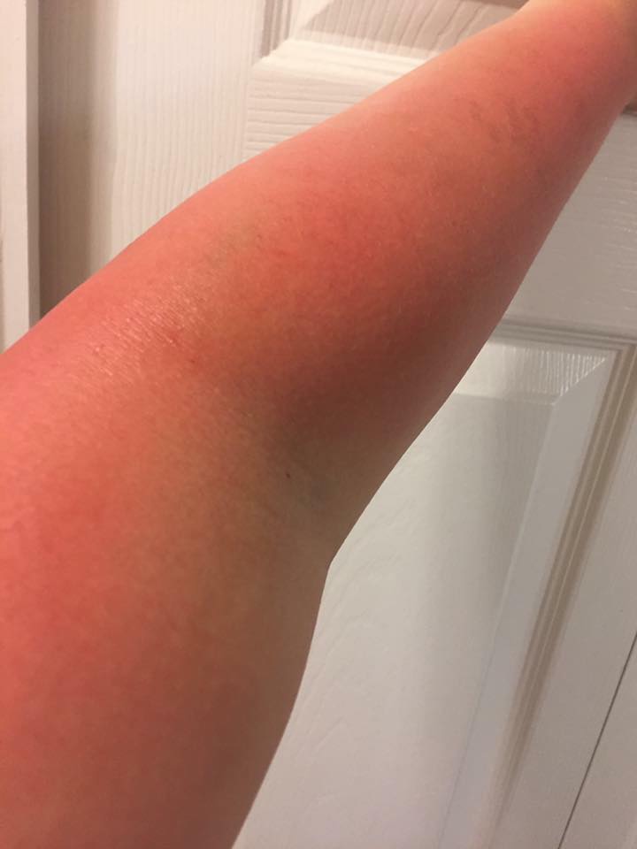 a woman's arm looks very red, similar to a sunburn