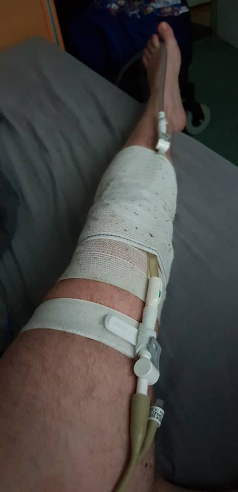 man's leg with a catheter taped to it
