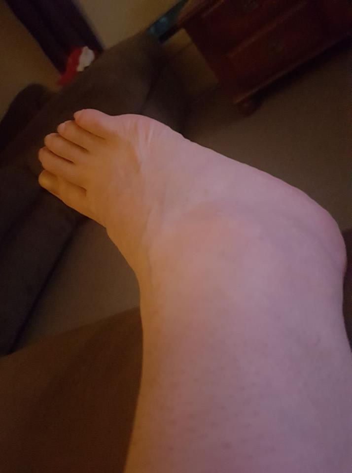 a woman's swollen foot and ankle