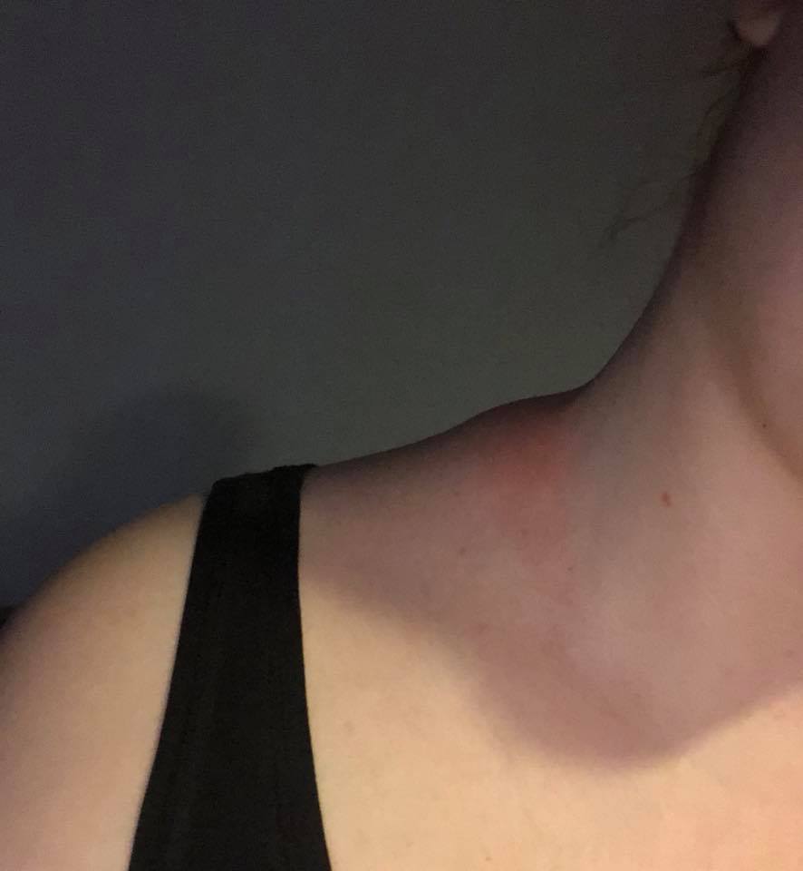 red and irritated lump on a woman's shoulder where her bra strap was