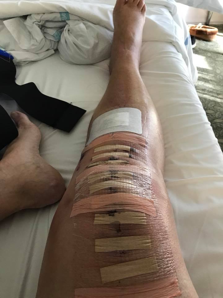 bandages over a scar from a total knee replacement