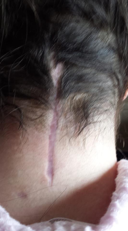 wide scar on the back of a woman's neck